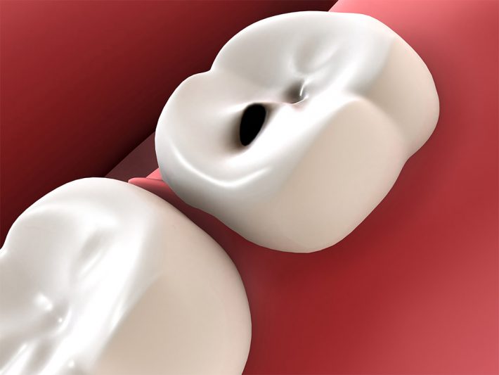 caries