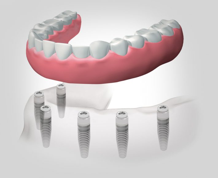 implantes dentales en León