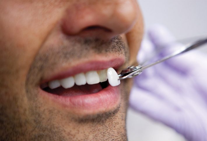 carillas dentales