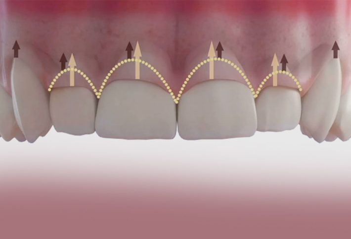 gingivectomia