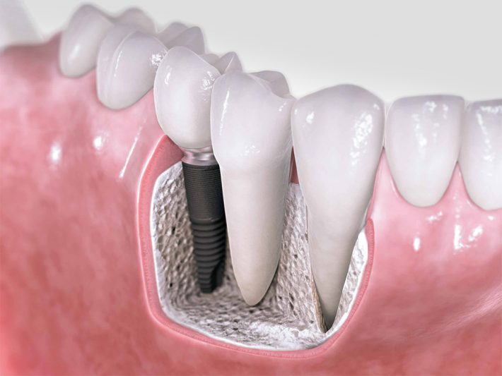 implantes dentales en León