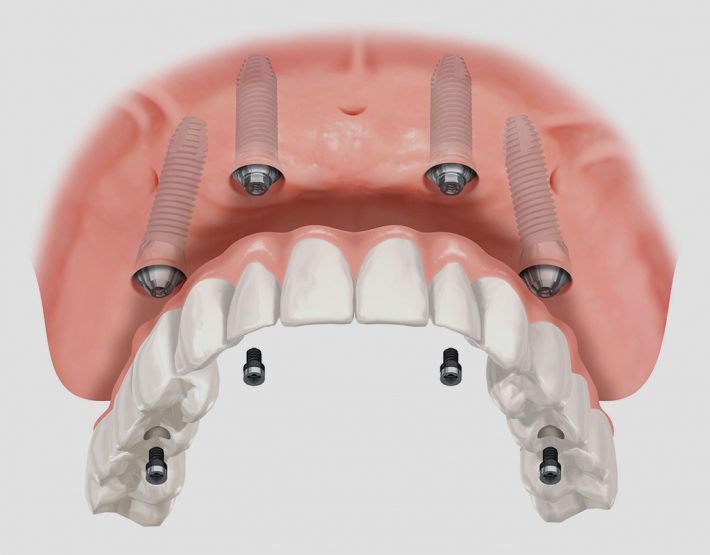 implantes dentales en León