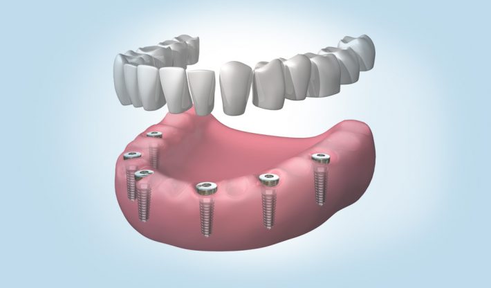 implantes dentales en León