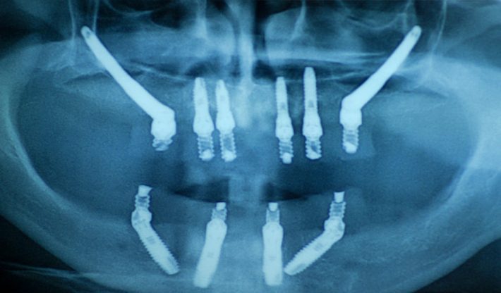 implantes dentales en León