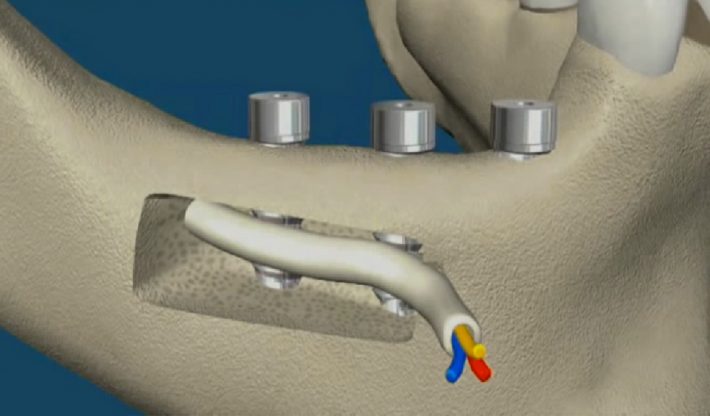implantes dentales en León