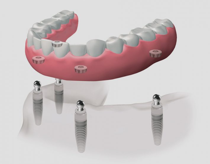 implantes dentales en León