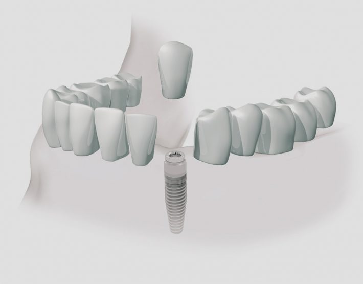 implantes dentales en León