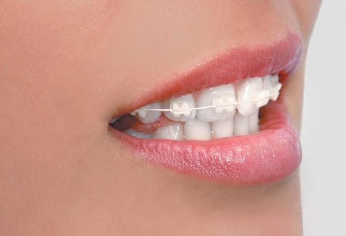 ortodoncia estética